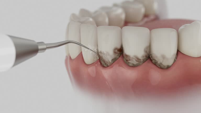 Trusted Wisdom Tooth Removal service in Arkoma, OK - Dentist Open Now